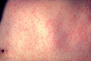 The Characteristic measles rash